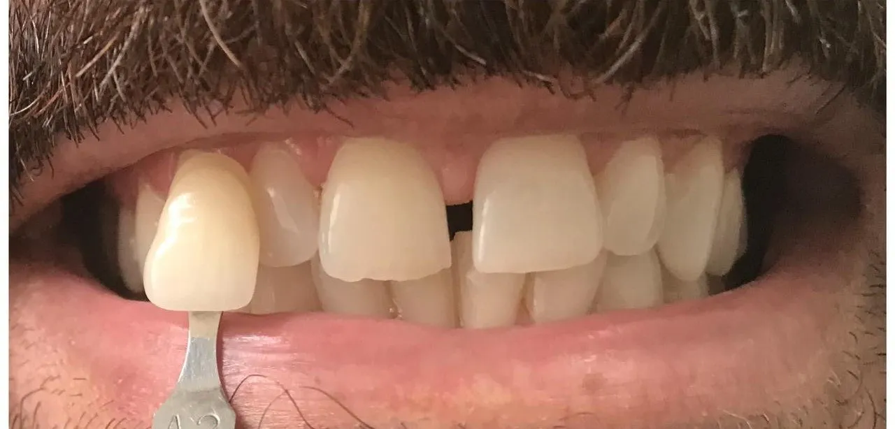Sorriso antes do tratamento, com dentes desalinhados e desgastados