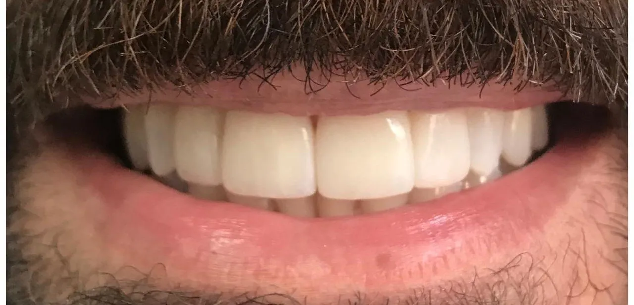 Sorriso depois do tratamento multidisciplinar
